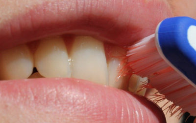 Mundhygiene nach dem Zahnersatz