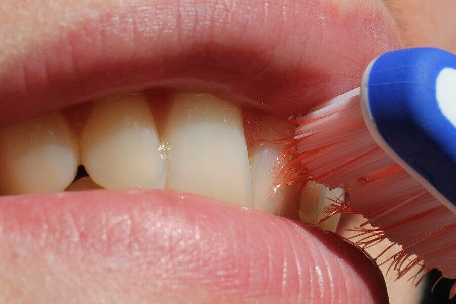 Mundhygiene nach dem Zahnersatz