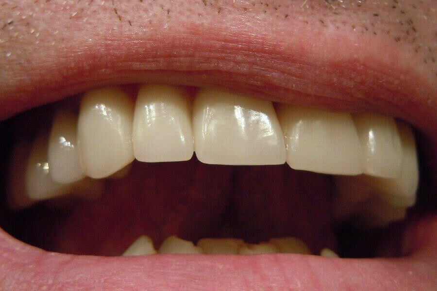 Rögzített fogsor