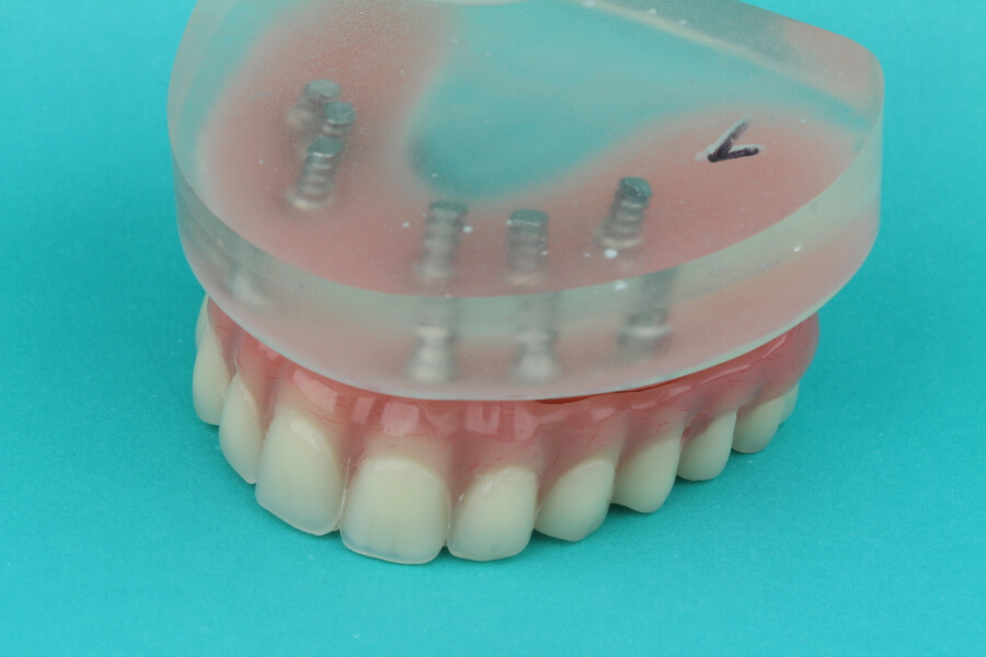 implantagetragener, festzsitzender Zahnersatz